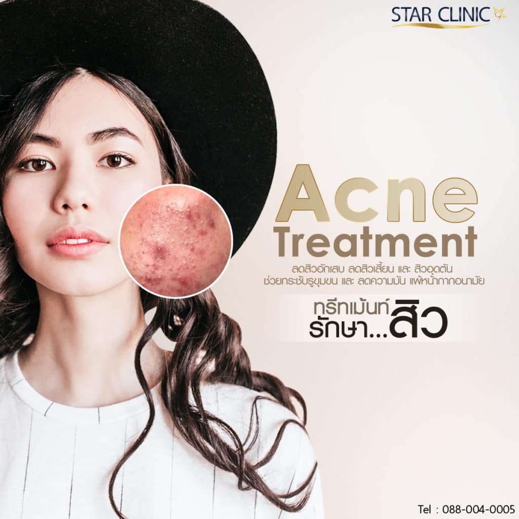 Acne Treatment ทรีทเม้นท์รักษาสิว ผิวหน้าใส